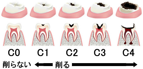 虫歯 豊橋駅前歯科 矯正歯科